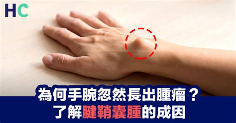 劍鞘腫|手腕背側腫了一顆，原來是「筋瘤」，腱鞘囊腫圖文懶。